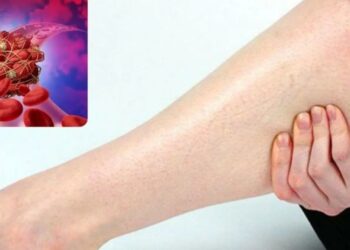 სისხლძარღვებში თრომბის არსებობის ნიშნები, რასაც ყურადღება უნდა მიაქციოთ!