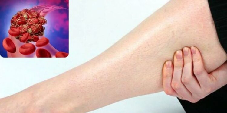 სისხლძარღვებში თრომბის არსებობის ნიშნები, რასაც ყურადღება უნდა მიაქციოთ!