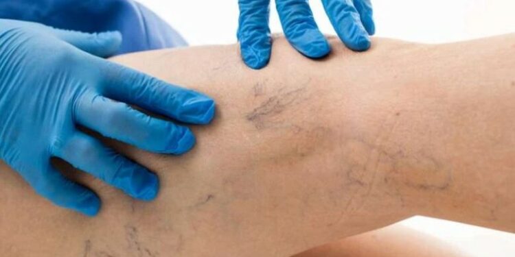 მთავარი ნიშნები, რომლებოთ სისხლძარღვებში საშიში თრომბის არსებობაზე მიუთითებს