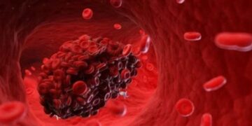 8 ნიშანი იმისა, რომ სისხლძარღვებში საშიში თრომბი გაქვთ